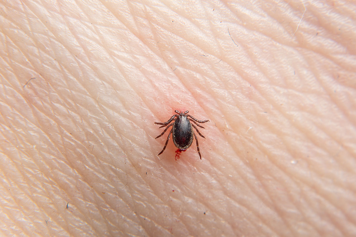 tick biting skin